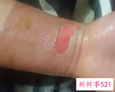 烫伤后破了能抹烫伤膏吗