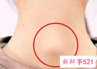 富贵包是什么原因引起的