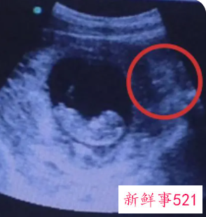 怀孕初次b超的最佳时间排除宫外孕