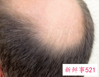 染发的危害有哪些