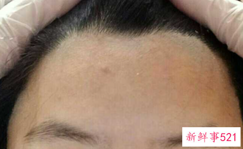 坚守发际线的底线