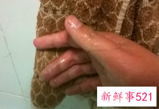 烫住手指头怎么办