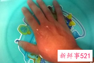 烫住手指头怎么办