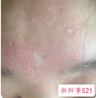 脸部皮肤干燥是怎么回事