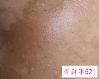 如何慢慢淡化雀斑