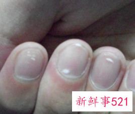 手指指甲出现白点是怎么了