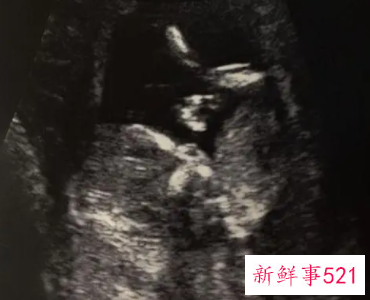 怀孕初次b超最佳的时间