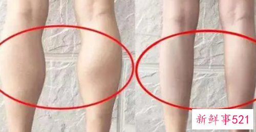 肌肉型小腿怎么办