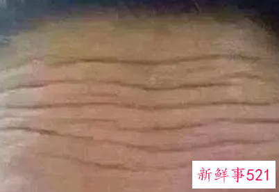 三十岁额头上有皱纹怎么办