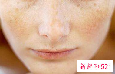 去日晒斑的方法有哪些