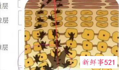 黑色素斑怎么消除