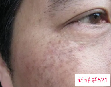 脸上长黑斑有的治吗