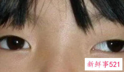 眼睛斜视的危害