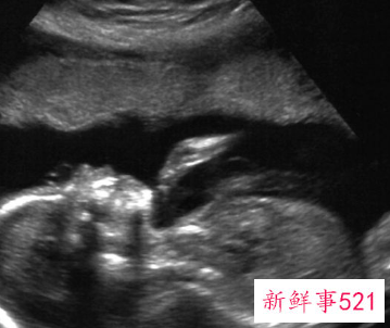 怀孕什么时候做b超合适