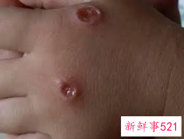 小孩子起水痘怎么治