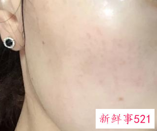 用激光点痣会留疤吗