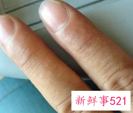 手指指甲出现白点是怎么了