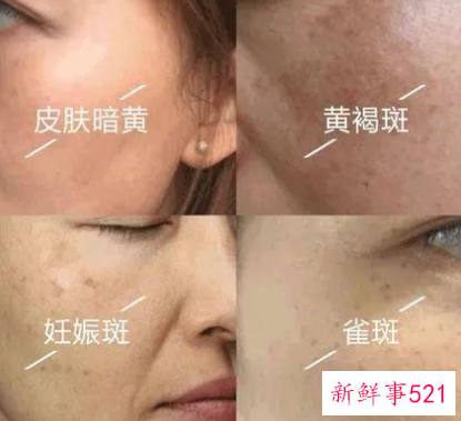 如何去除蝴蝶斑