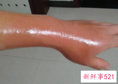 烫伤后破了能抹烫伤膏吗