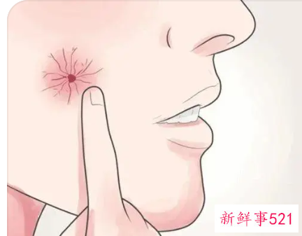 去痦子有几种方法