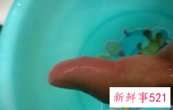 烫住手指头怎么办