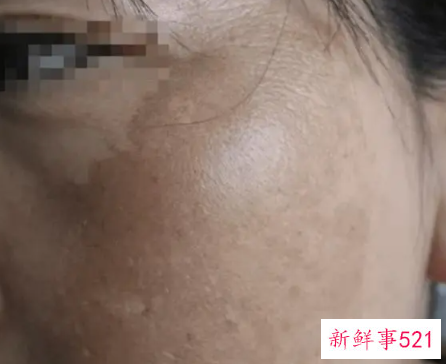 如何去除蝴蝶斑