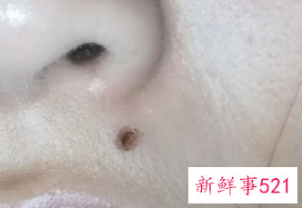 用激光点痣会留疤吗