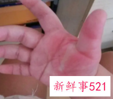 烫住手指头怎么办