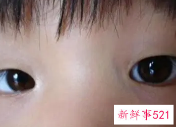 眼睛斜视的危害