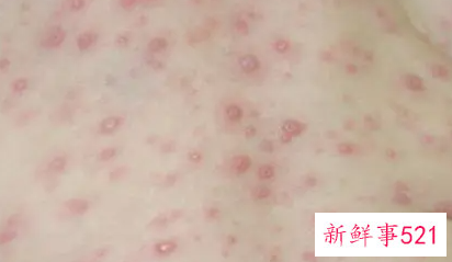 小孩子起水痘怎么治