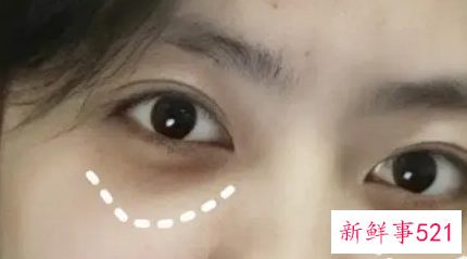 怎么才能快速消除黑眼圈