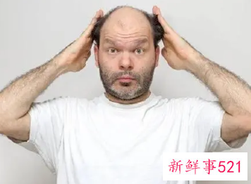 男性脱发原因大盘点