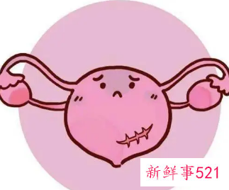 先兆子宫破裂四大表现