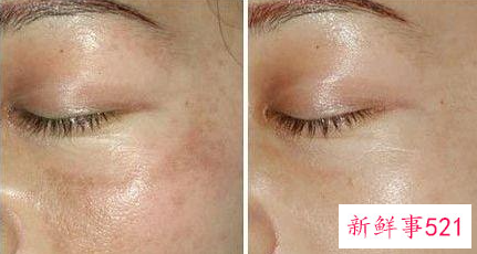 去日晒斑的方法有哪些