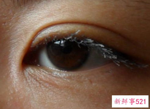 眼睛浮肿怎么办