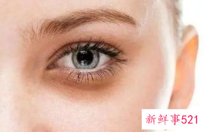 怎么才能快速消除黑眼圈