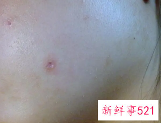 用激光点痣会留疤吗