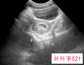 怀孕初次b超最佳的时间