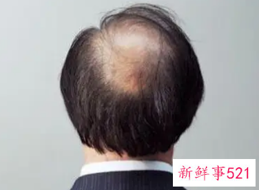 男性脱发原因大盘点