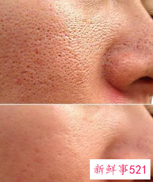 怎么改善脸部毛孔粗大