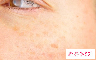 脸上长黑斑有的治吗