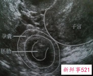 怀孕初次b超的最佳时间排除宫外孕