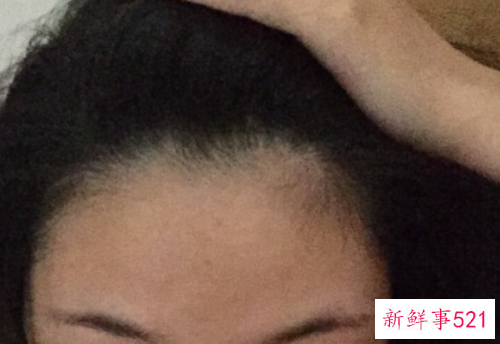 坚守发际线的底线