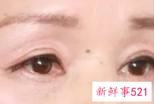眼皮下垂解决方法