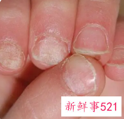 手指指甲出现白点是怎么了