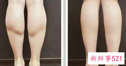 肌肉型小腿怎么办