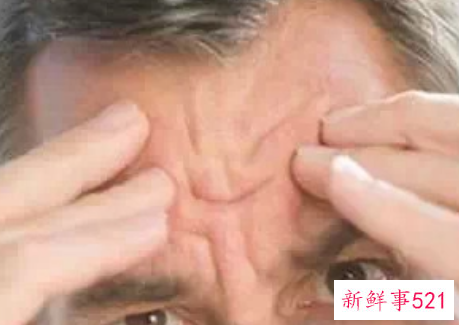 三十岁额头上有皱纹怎么办