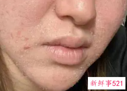 脸上起皮和白色碎屑是什么原因