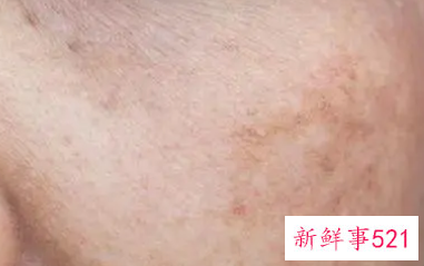 脸上的色素沉着怎样处理