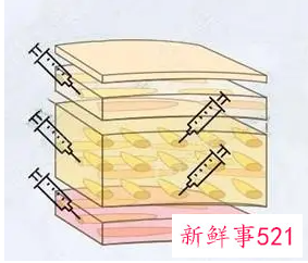 隆胸自体脂肪填充能维持几年